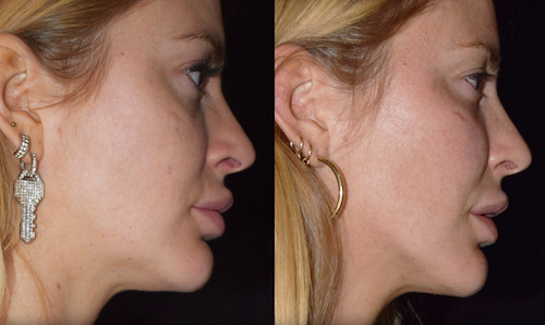 non surgical facelift before after cheek filler mississauga oakville